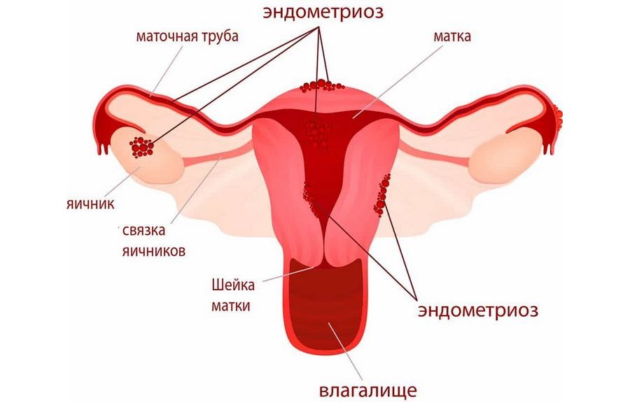 эндометриоз