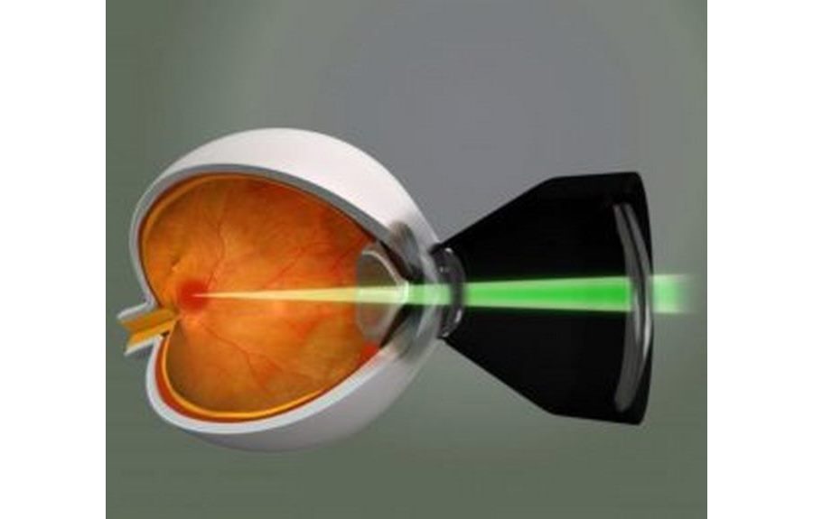 Лазерная коагуляция сетчатки глаза при беременности